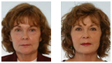 Before and After Skin Care Services in Houston, TX