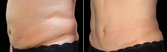 CoolSculpting Before and After Photos in Houston, TX, Patient 7780