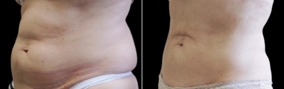 CoolSculpting Before and After Photos in Houston, TX, Patient 7817