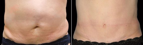 CoolSculpting Before and After Photos in Houston, TX