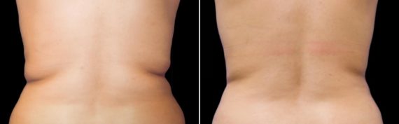 CoolSculpting Before and After Photos in Houston, TX, Patient 7803