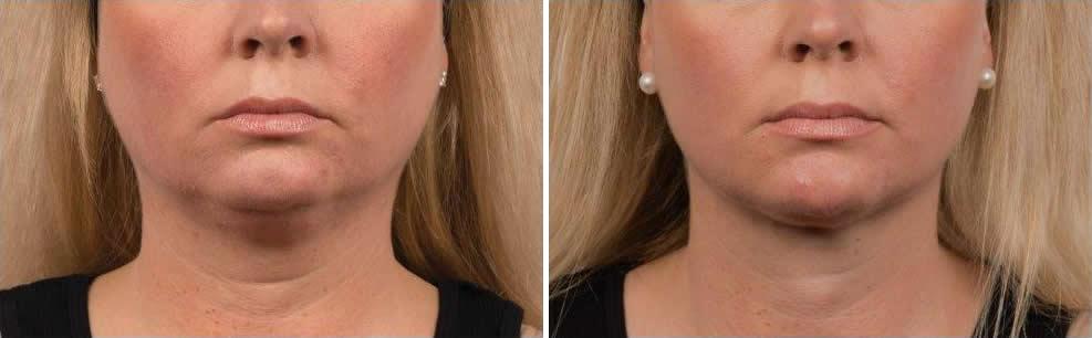 Front View Before & After Patient Photos | Neck Rejuvenation Houston, TX | Mirror Mirror Beauty Boutique