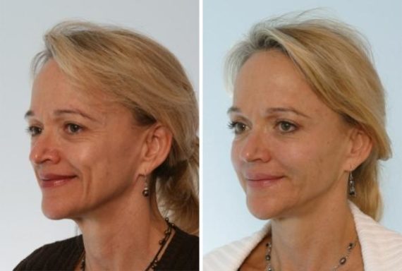 Fillers Before and After Photos in Houston, TX, Patient 7923