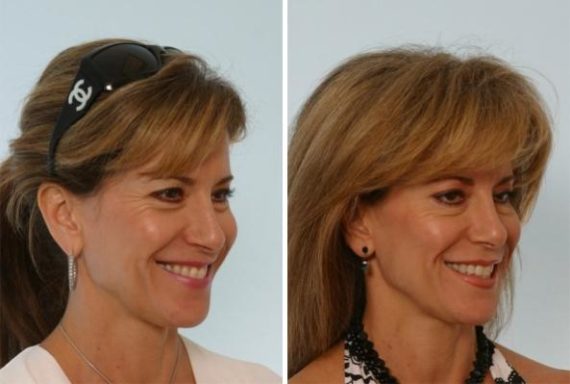 Fillers Before and After Photos in Houston, TX, Patient 7928