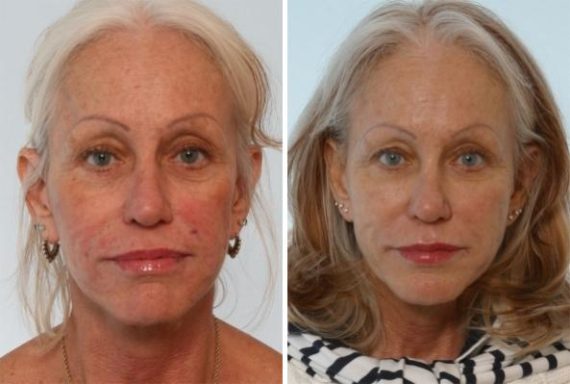 Fillers Before and After Photos in Houston, TX, Patient 8011