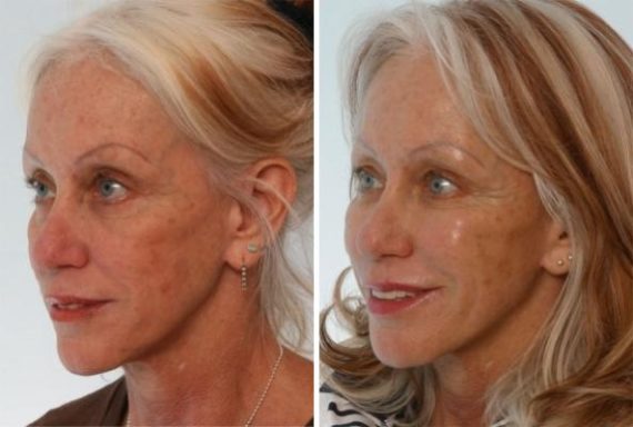 Fillers Before and After Photos in Houston, TX, Patient 8011