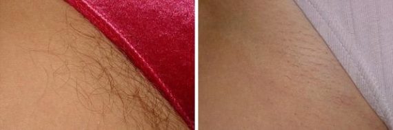 Laser Hair Removal Before and After Photos in Houston, TX