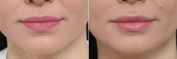 Lip Enhancement Before and After Photos in Houston, TX, Patient 8082