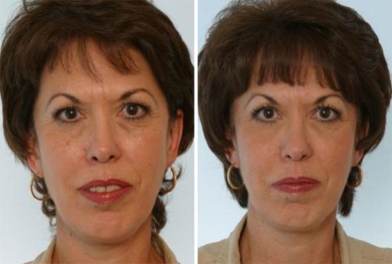 Fillers Before and After Photos in Houston, TX, Patient 8127