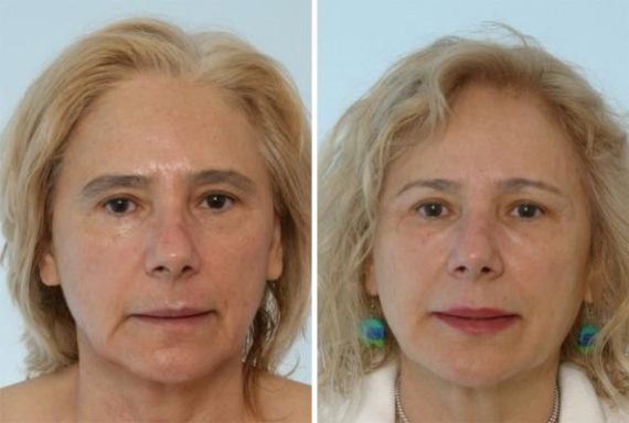 Fillers Before and After Photos in Houston, TX, Patient 8111