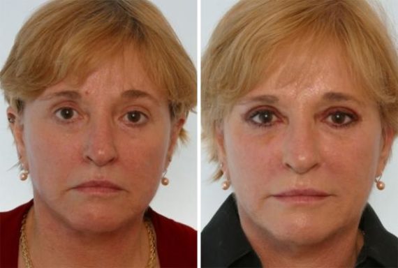 Fillers Before and After Photos in Houston, TX, Patient 8149