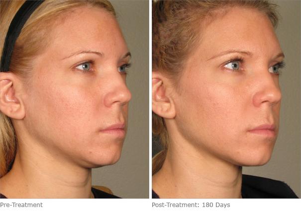 Before & After Patient Photos | Neck Rejuvenation Houston, TX | Mirror Mirror Beauty Boutique