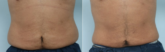 CoolSculpting Before and After Photos in Houston, TX, Patient 9461