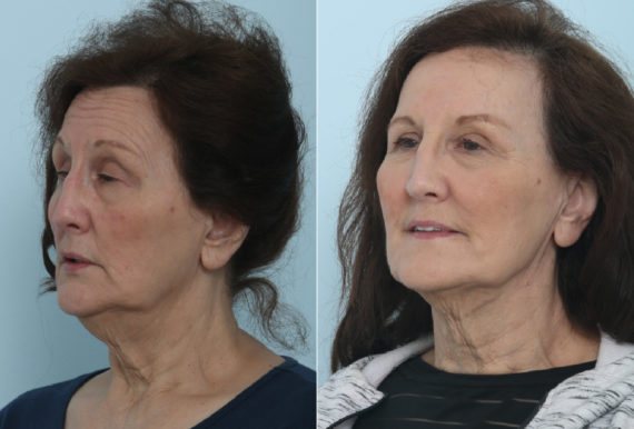 Fillers Before and After Photos in Houston, TX, Patient 9453