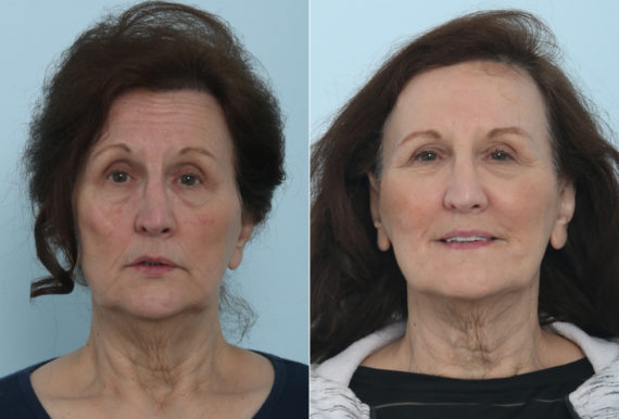 Fillers Before and After Photos in Houston, TX, Patient 9453