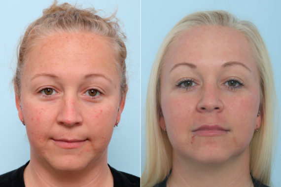 Fraxel Laser Before and After Photos in Houston, TX, Patient 9770