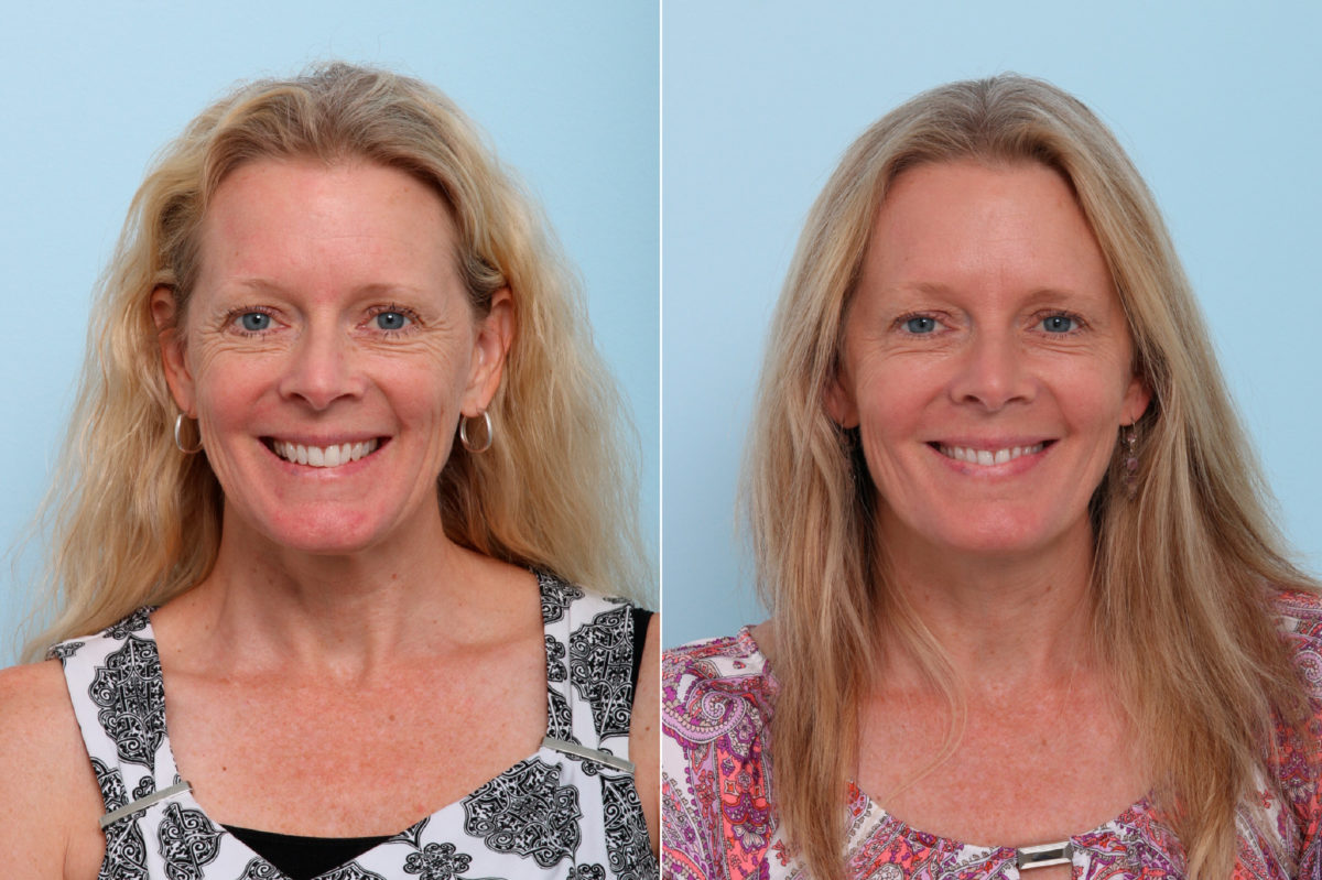 Botox® Cosmetic & Xeomin Before and After Photos in Houston, TX, Patient 7750