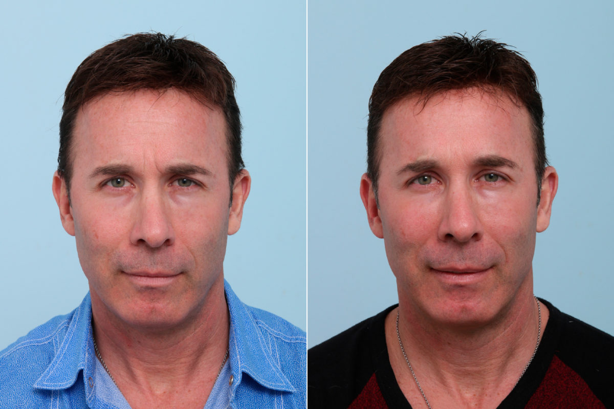 Botox® Cosmetic & Xeomin Before and After Photos in Houston, TX, Patient 7757