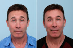 Botox® Cosmetic & Xeomin Before and After Photos in Houston, TX, Patient 7757