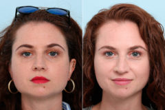 Botox® Cosmetic & Xeomin Before and After Photos in Houston, TX, Patient 10367