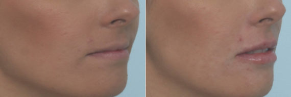 Lip Enhancement Before and After Photos in Houston, TX, Patient 10478