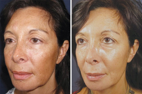 Chemical Peels Before and After Photos in Houston, TX