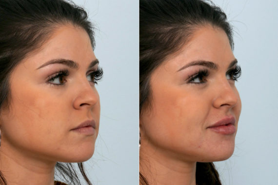 Fillers Before and After Photos in Houston, TX, Patient 10755