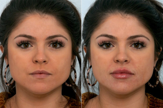 Fillers Before and After Photos in Houston, TX, Patient 10755