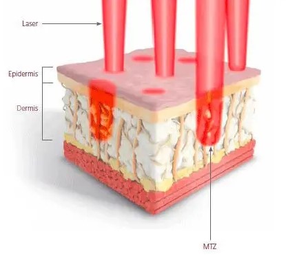 Fraxel Laser Treatments