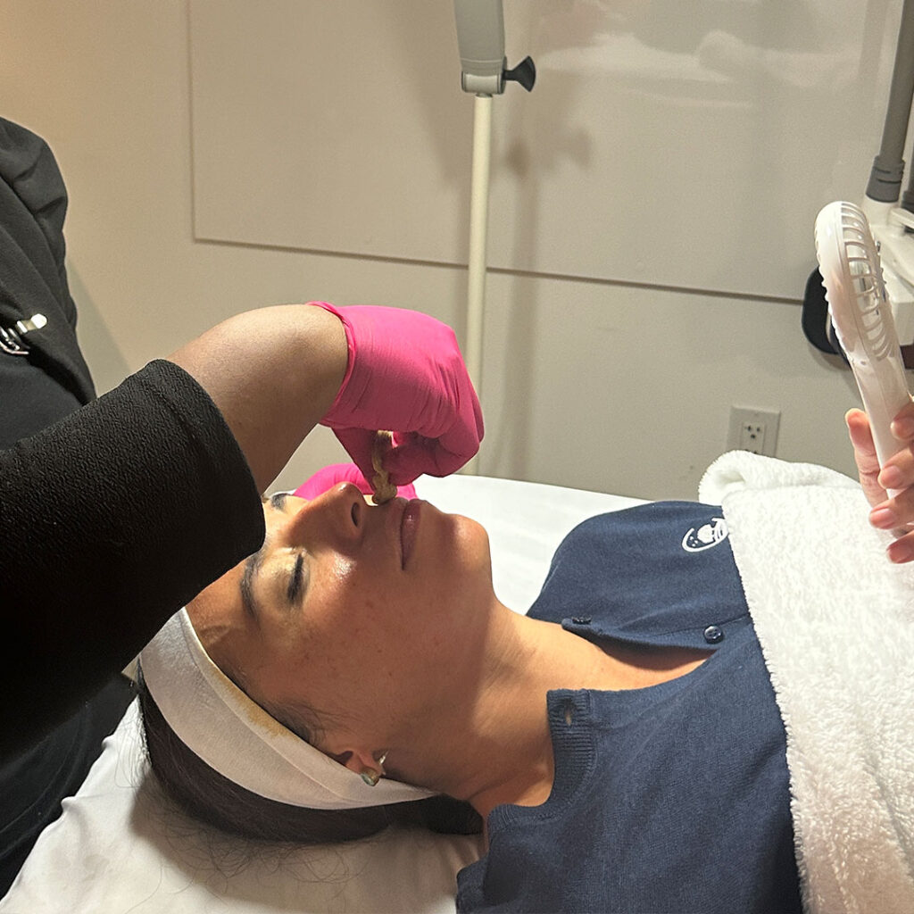 Deep peels include the TCA peel and phenolic acid peel. 