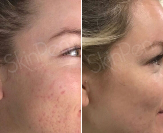 SkinPen® Microneedling Before and After Photos in Houston, TX, Patient 13686