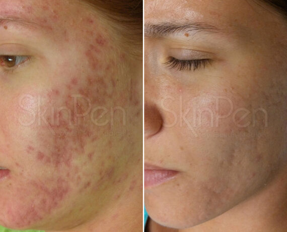 SkinPen® Microneedling Before and After Photos in Houston, TX