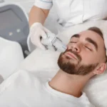 Benefits of Fraxel Laser Treatment for Men